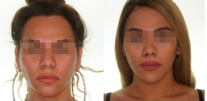 Cirugía de Feminización Facial en frente, nariz y mentón
